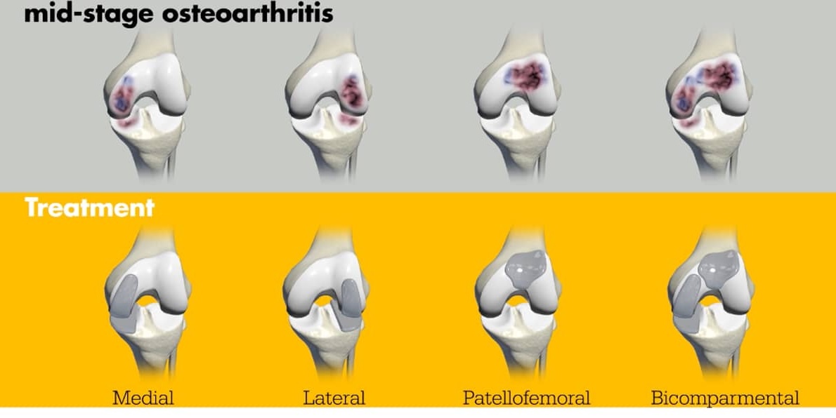 MAKO Robotic Partial Knee Replacement Types Illustration