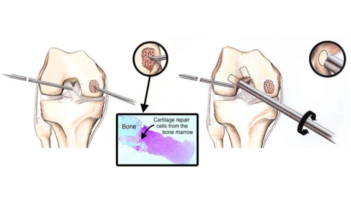 Why microfracture surgery with bone marrow repair cells