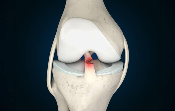 ACL Surgery Options 2025 ACL Rupture Injury