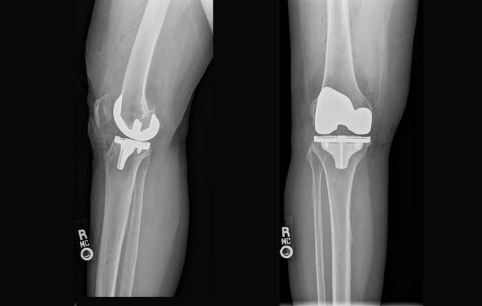 Total Knee Replacement Components Robotically Placed Total Knee Replacement Components Robotically Placed