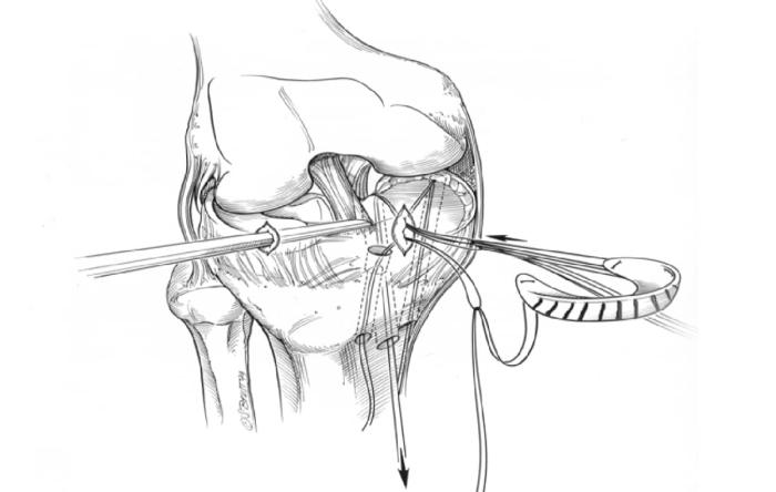 Meniscus Transplant Illustration Meniscus Transplant Illustration