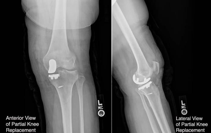 MAKO Partial Knee Replacement Robotically Placed Partial Knee Replacement