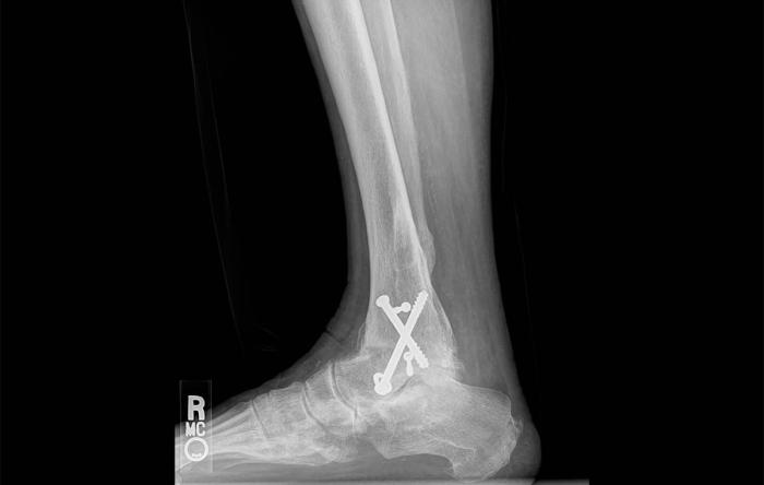 Ankle Fusion A Failure of Science Ankle Fusion A Failure of Orthopaedic Science