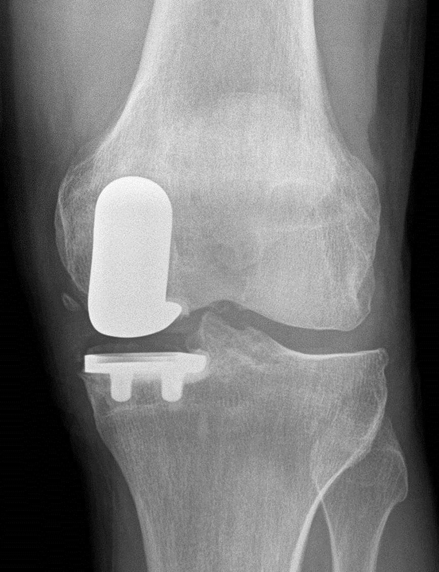 Outpatient Knee Replacement: The Great Debate | The Stone Clinic