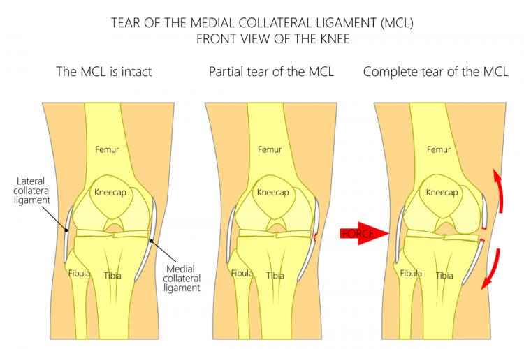 MCL Tear, Symptoms & Treatment