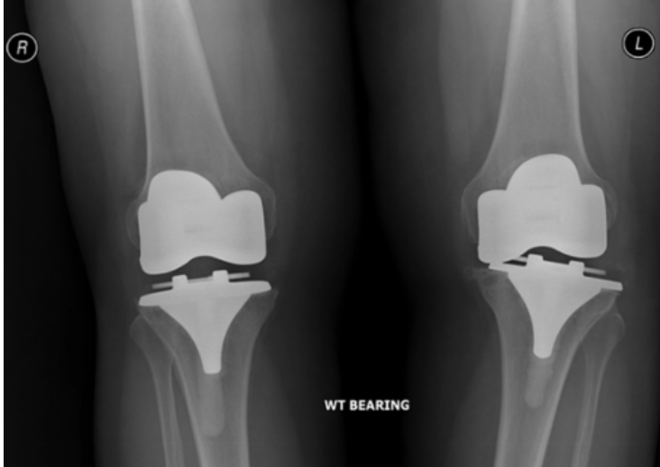 Total Vs. Partial Joint Replacement Surgery