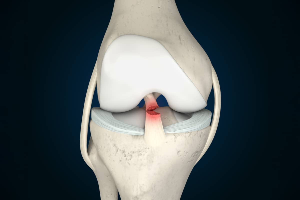 ACL Rupture Injury
