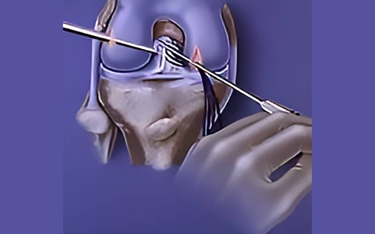 ACL Repair vs Replacement