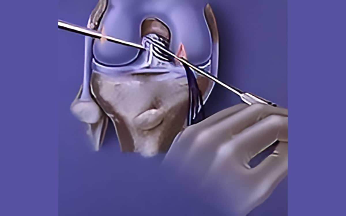 ACL Repair Revisited