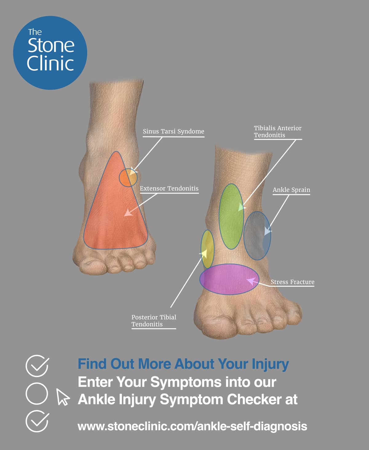 Outside Ankle Pain (Lateral) - Symptoms, Causes & Treatment & Rehab