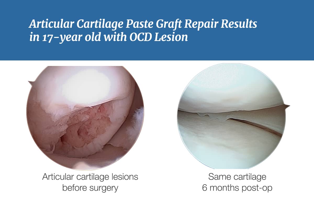 Before and After Cartilage Repair Surgery - ArtCart Results