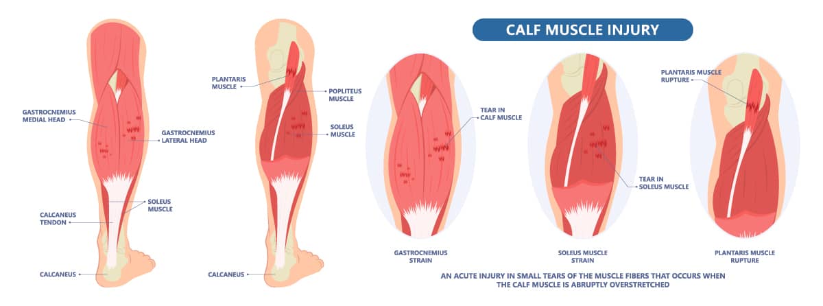 illustration of biology and medical, calf tear and Torn Calf