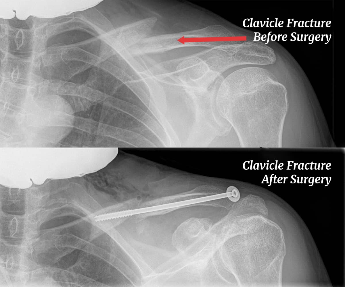 Innovative Clavicle Fracture Repair