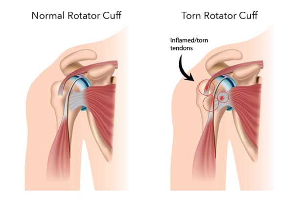 Torn Rotator Cuff: Causes, Symptoms & Treatment