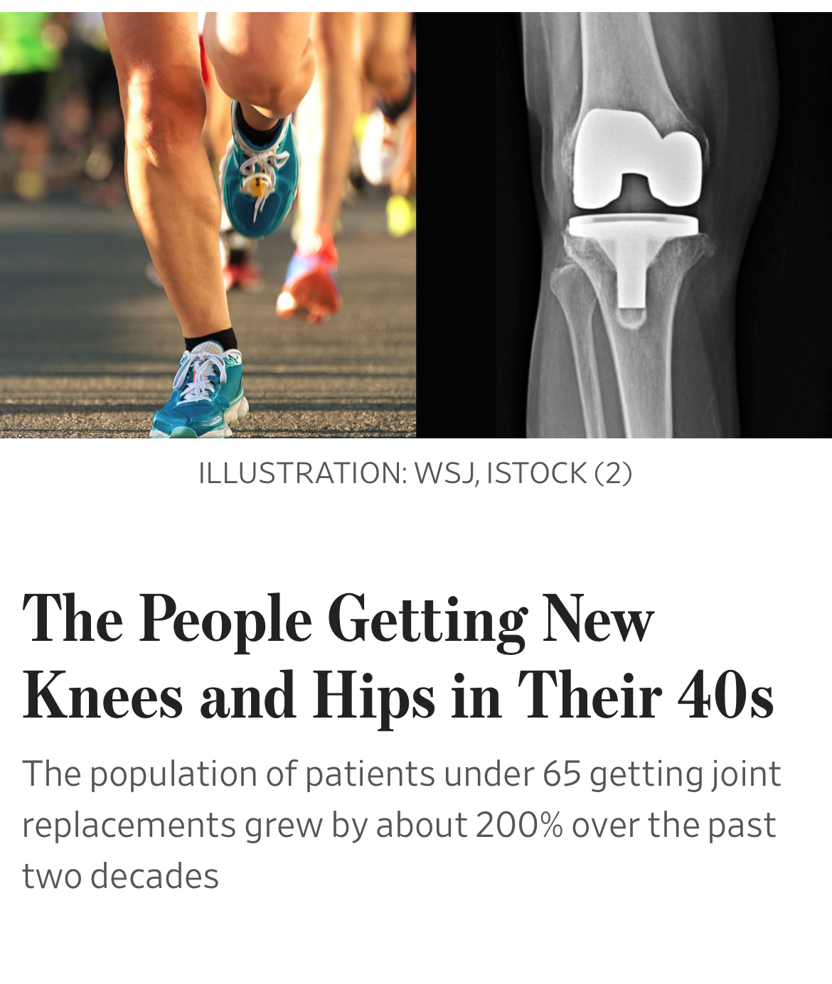 The People Getting New Knees and Hips in Their 40s. WSJ Kevin Stone, MD