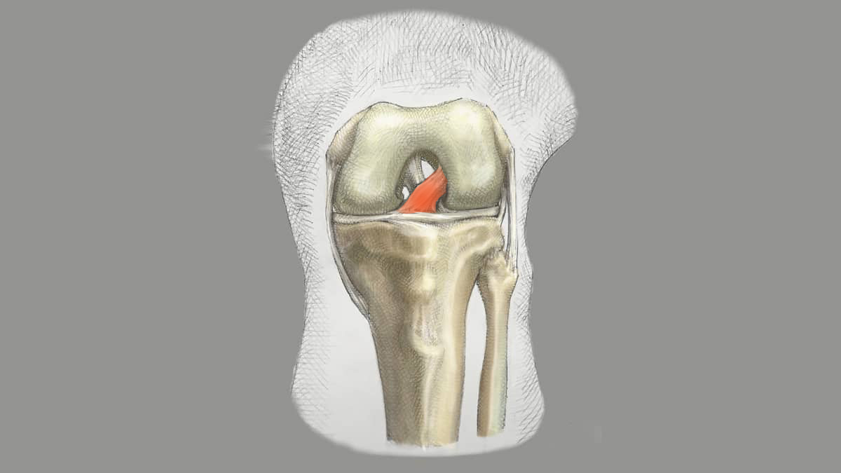 Do You Need ACL Surgery for a Tear?