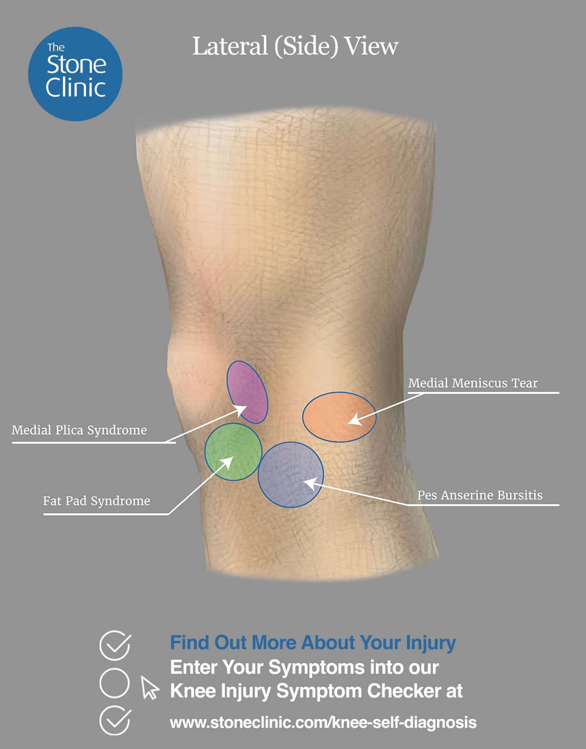 Knee Pain Symptom Checker [Online Knee Injury Self Diagnosis Tool]