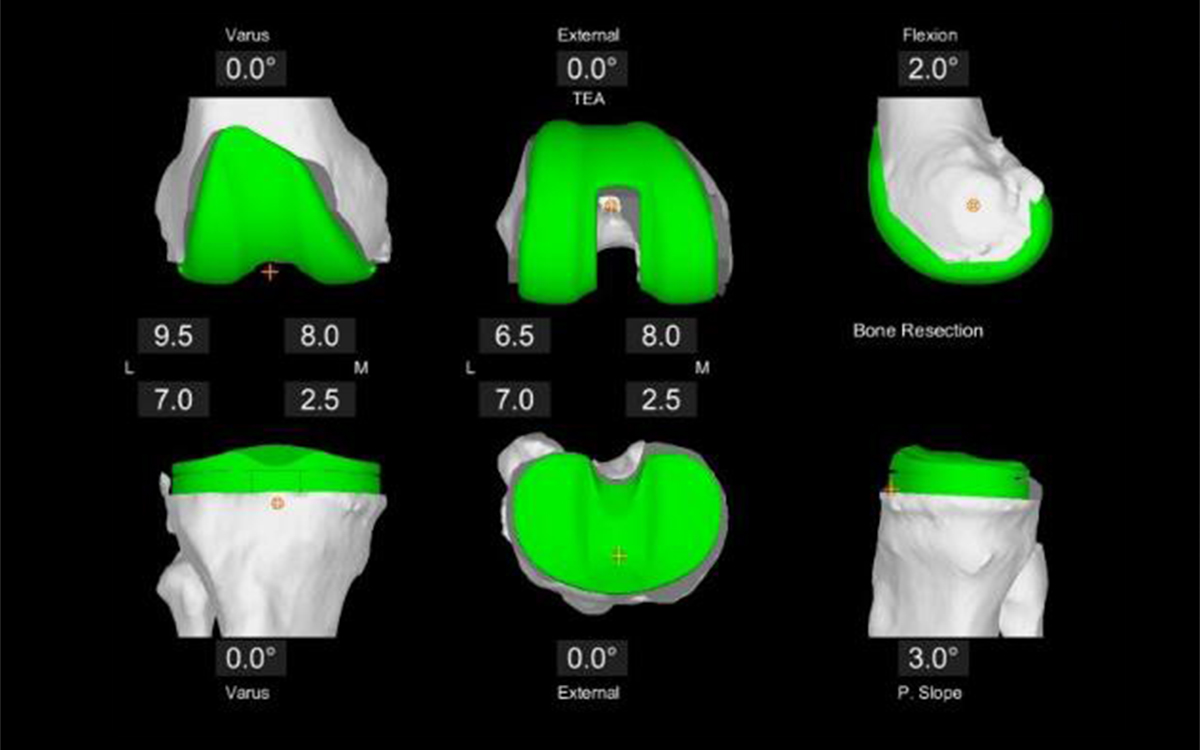 MAKO Total Knee Planning Surgery