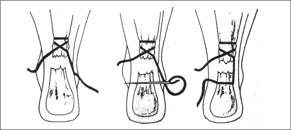 Achilles Tendon Tear Rupture Injury | Treatment & Recovery