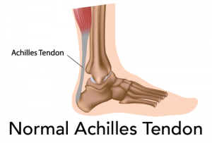 healing a strained achilles tendon