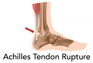 Achilles Tendon Repair Rehab Protocol & Recovery Time Frame