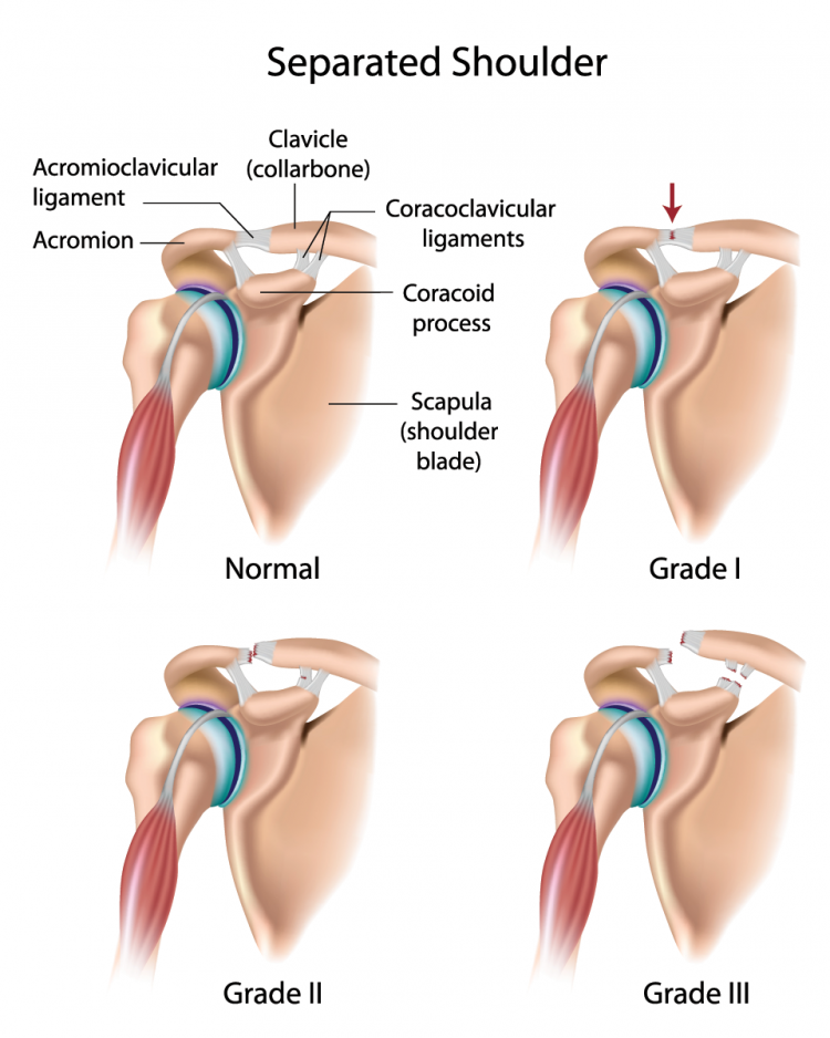 Acromioclavicular injury