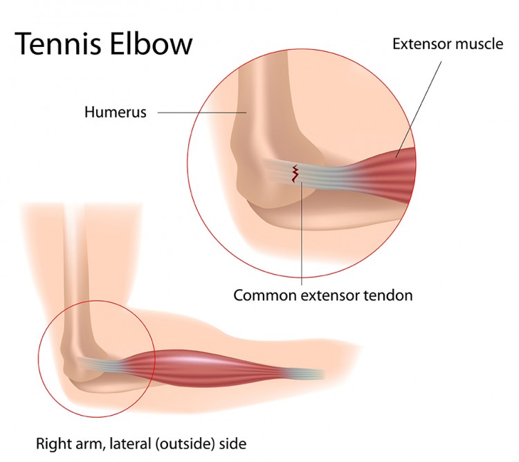 Elbow Injury Torn Tendons Tendonitis Repair