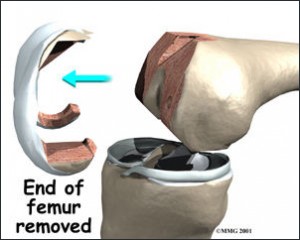 Total knee replacement surgical technique | The Stone Clinic