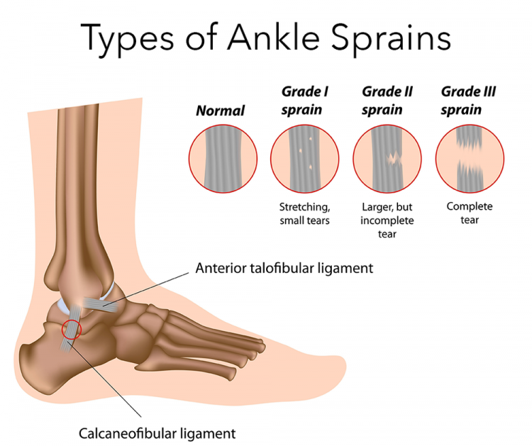 Ankle Sprain | Symptoms, Treatment 