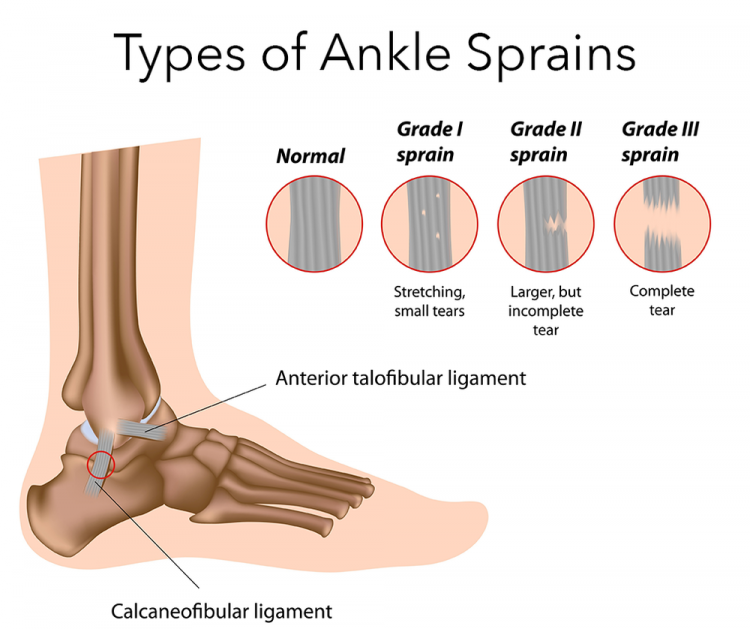 Ankle Sprain Symptoms Treatment Recovery Time