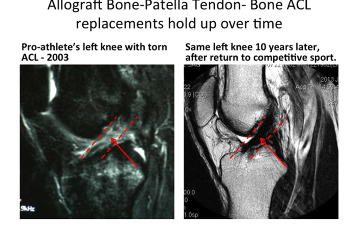 Donor tissue best for ACL reconstruction