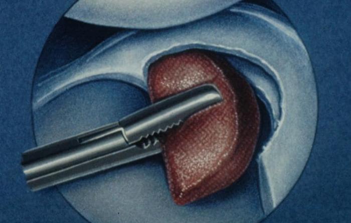 Repair of Segmental Meniscal Defects The Stone Clinic