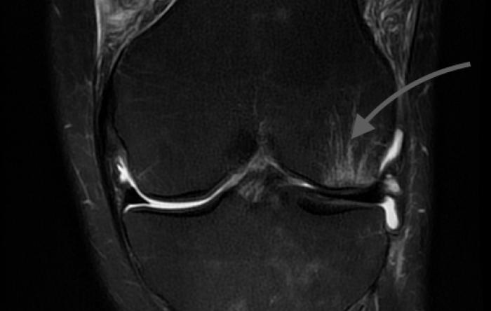 Bone Bruise MRI