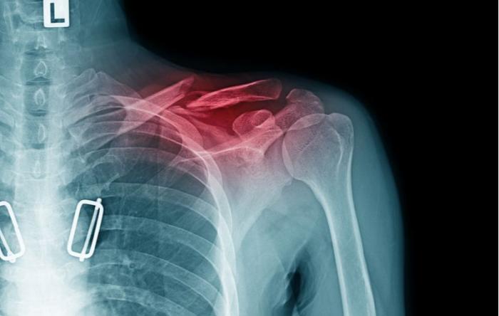 Repair of Clavicle Fractures