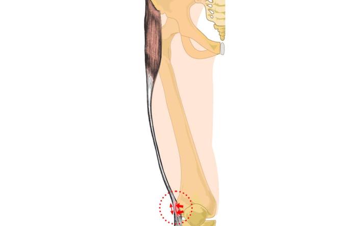 Iliotibial Band (ITB) Tendonitis 