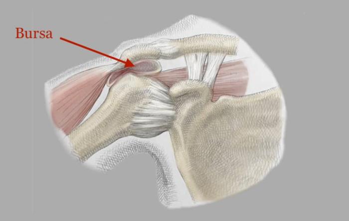 Anatomical sketch of shoulder bursitis