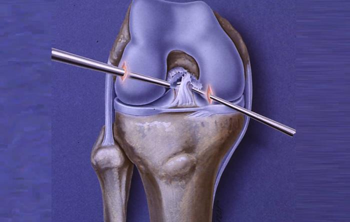 ACL Arthritis Surgery