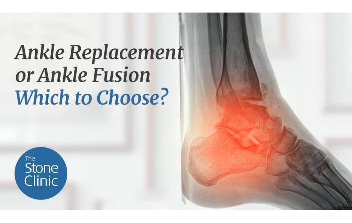 Ankle Replacement or Ankle Fusion