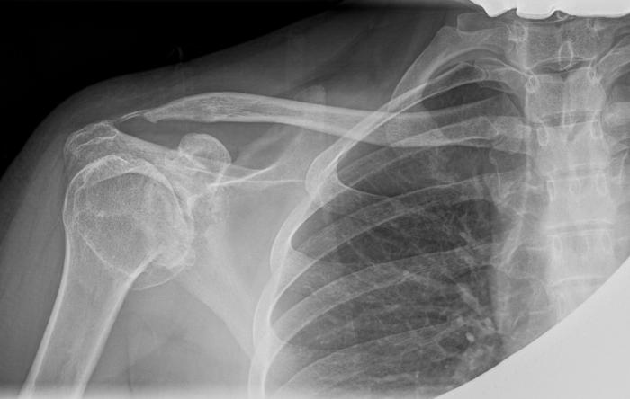 Shoulder Arthritis