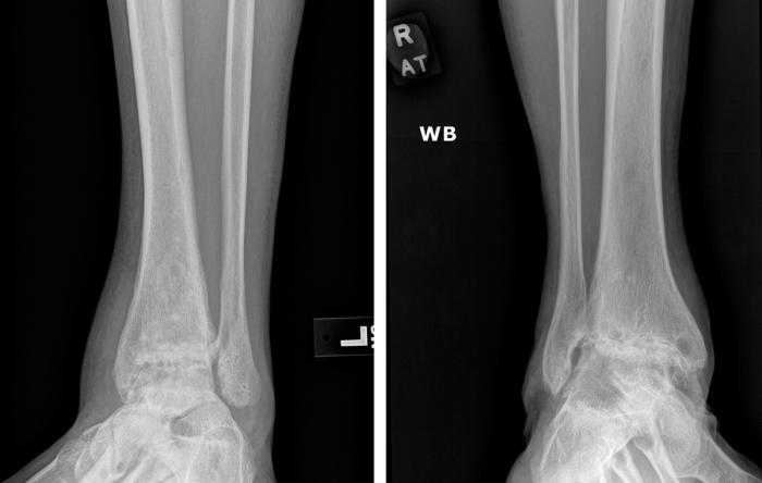 When to Have Ankle Surgery