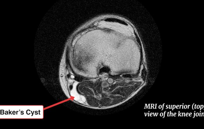 Bakers Cyst MRI