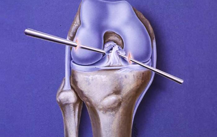 Do You Repair a Failed ACL Surgery