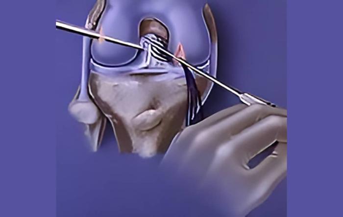 ACL Repair vs Replacement