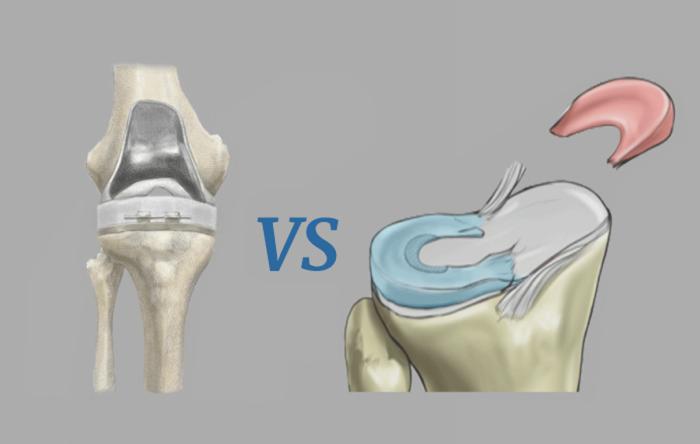 Alternatives to Total Knee Replacement