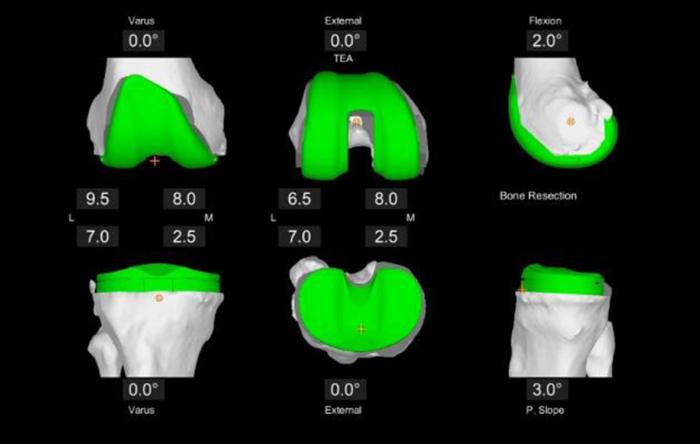 MAKO Total Knee Planning Surgery