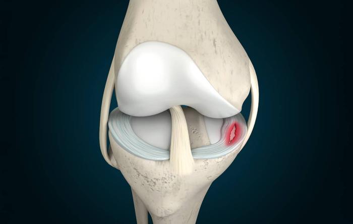 Modern Ways to Repair Meniscus Tears