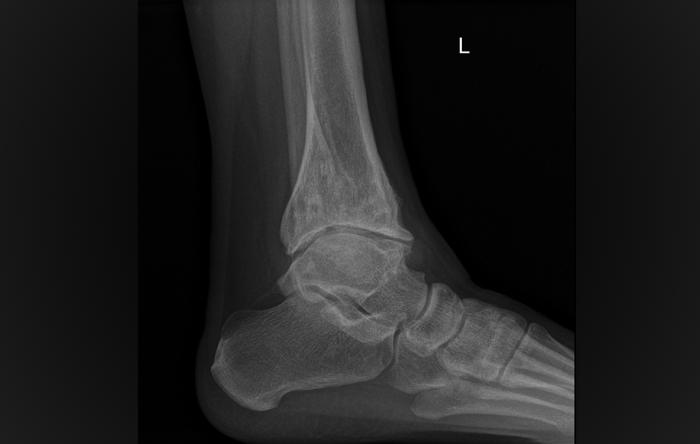 How to Treat Arthritic Ankles  Best Way to Treat Arthritic Ankles