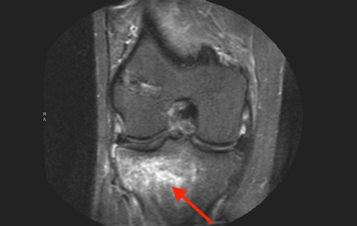 Stress Fractures How To Treat