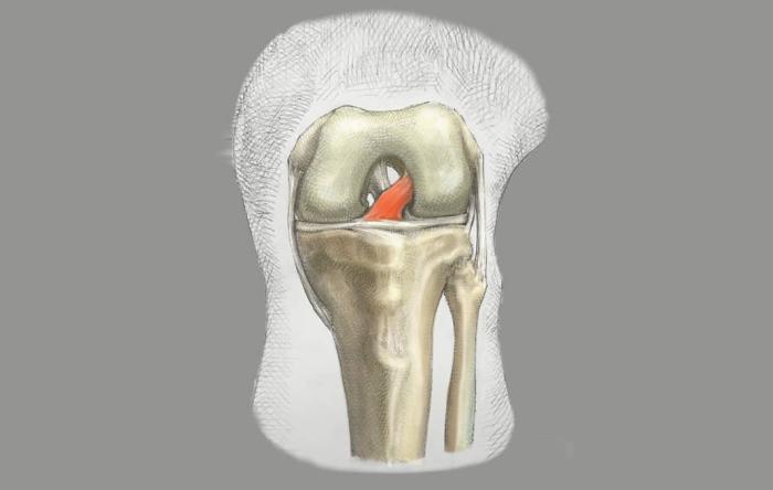 Do You Need an ACL? Do You Need an ACL?