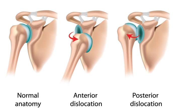 Shoulder Dislocation Treatment Shoulder Dislocation Treatment
